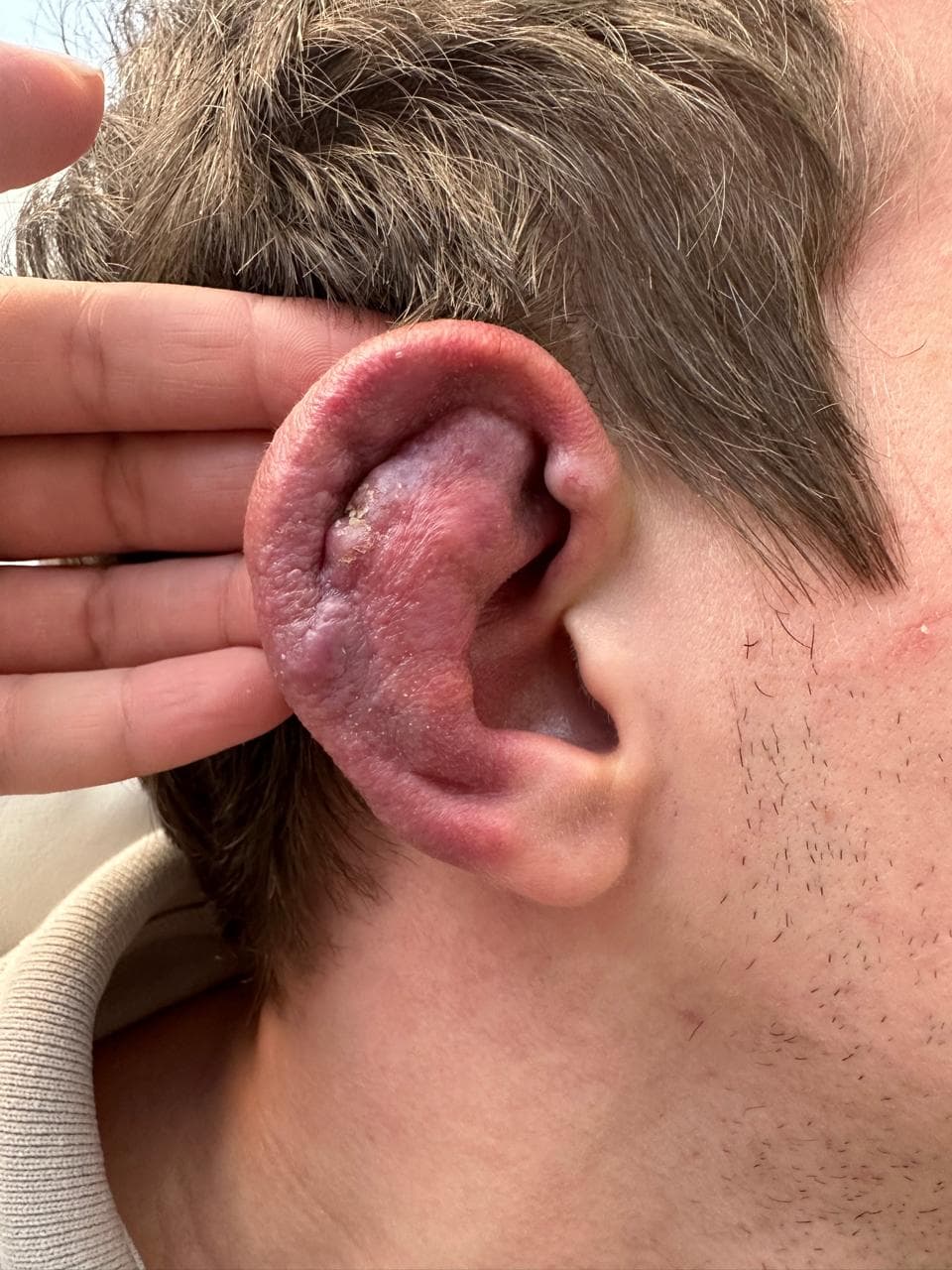 Malformação arteriovenosa na orelha