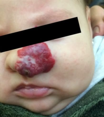 Hemangioma infantil ulcerado no nariz de um bebê