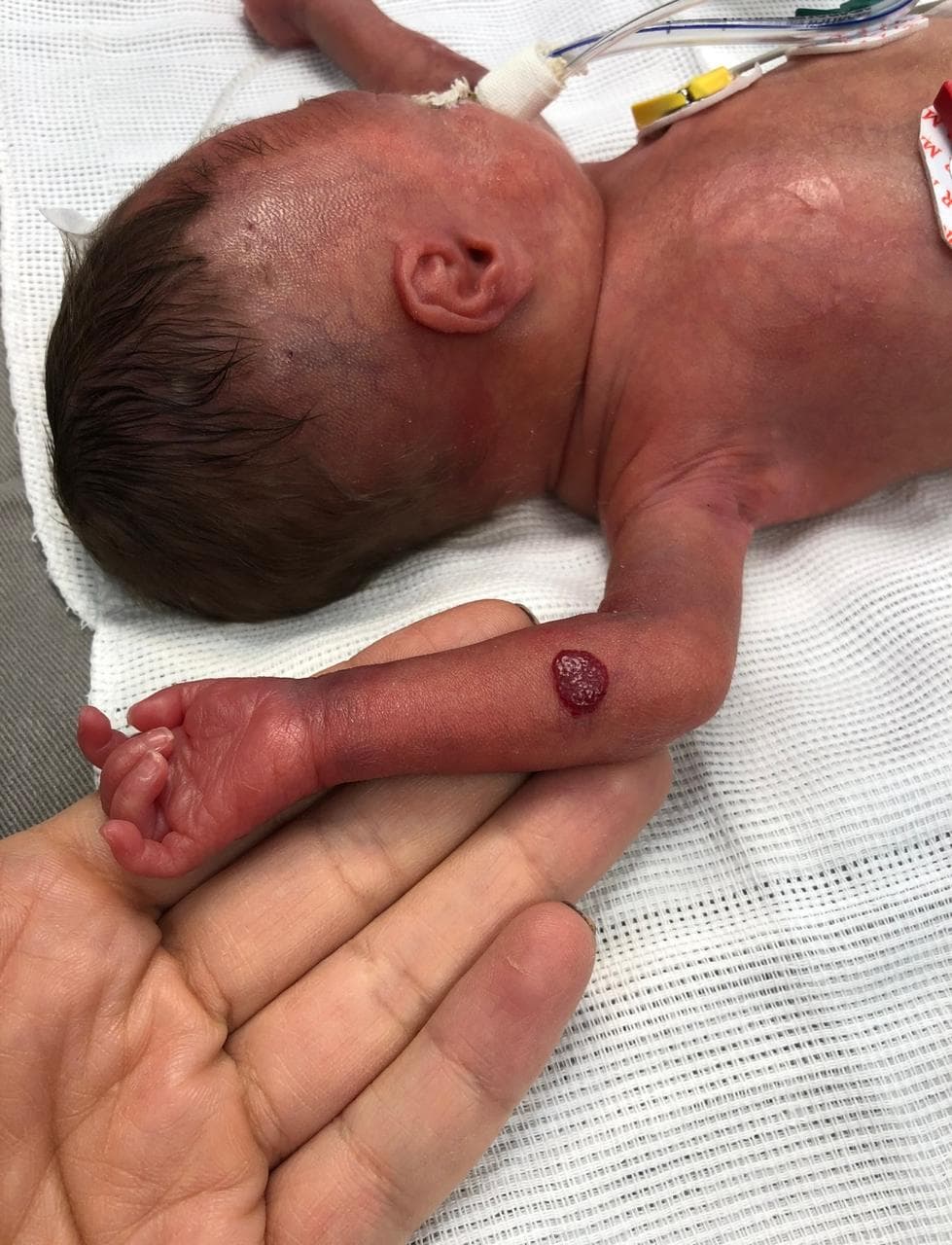 Hemangioma infantil no braço de um recém-nascido prematuro