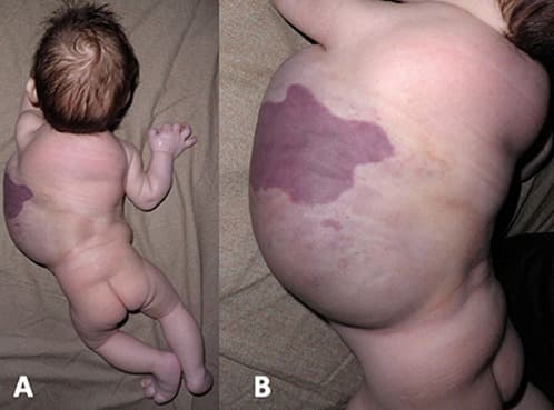Mancha vinhosa extensa com assimetria corporal em síndrome vascular