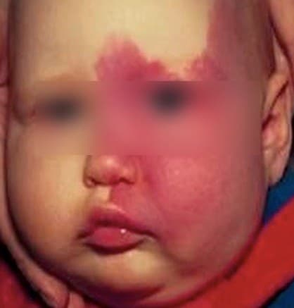 Malformação capilar na face de um bebê