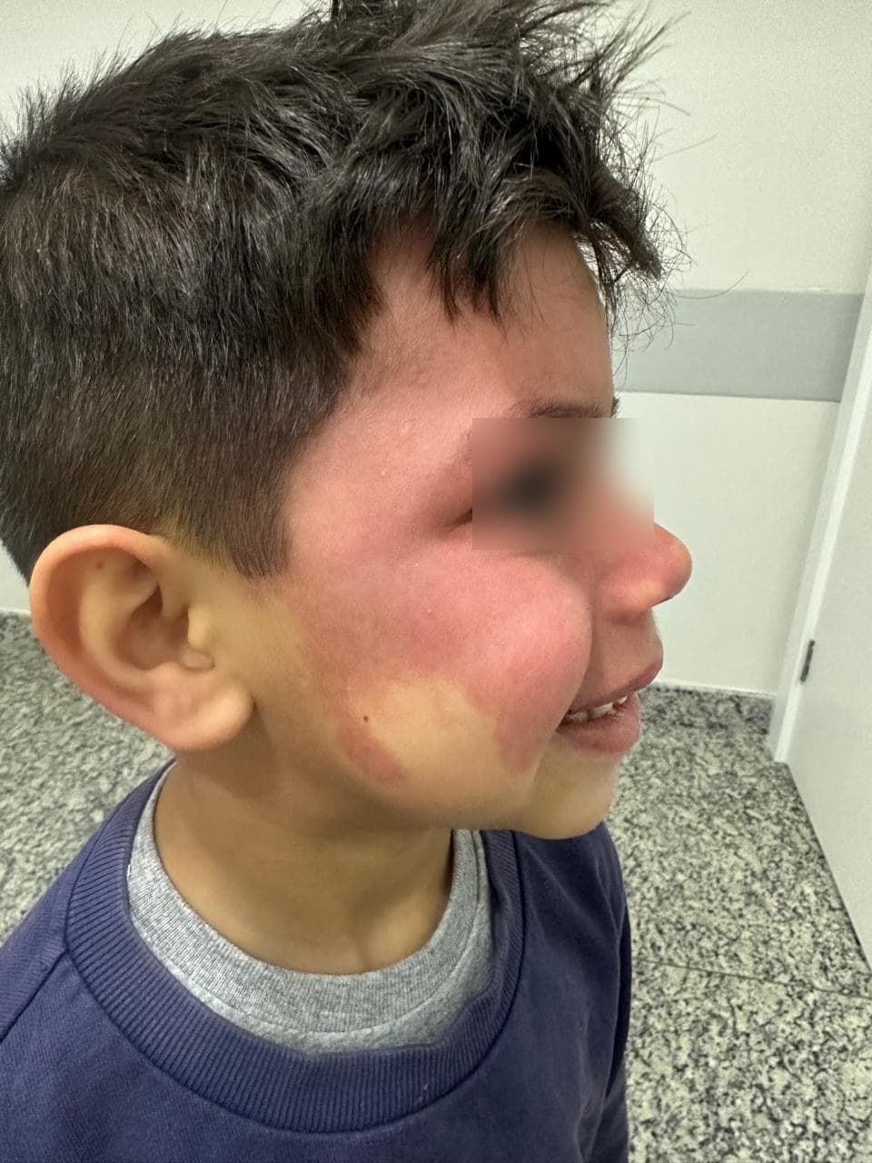 Menino com malformação capilar na face